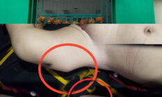 Keluarga Balita Pertanyakan Prosedur Puskesmas Cicalengka Diduga Usai Imunisasi Mengalami Pembengkakan